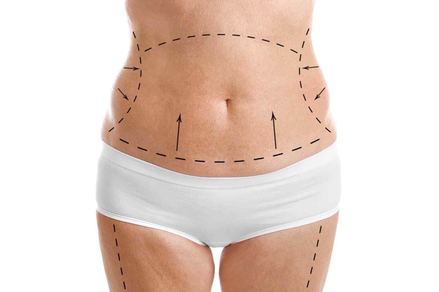 abdominoplastie