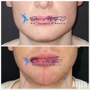 Chirurgie de féminisation faciale, FFS, MTF, réduction du menton, réduction de la mâchoire, Trans, Transgirl, Transwomen