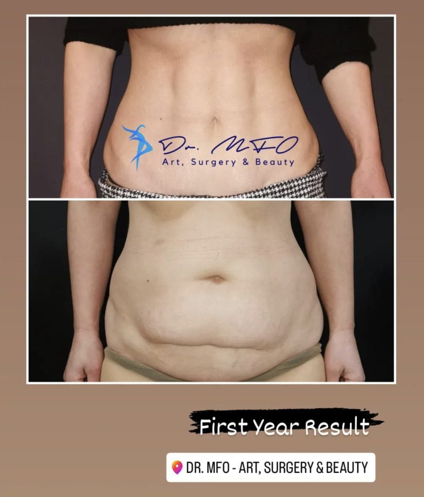 Abdominoplastie du ventre Venus et lipo 360 par le Dr MFO