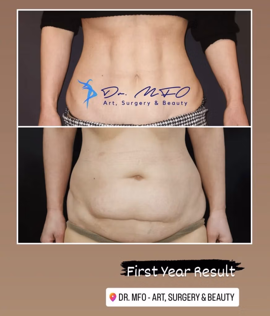 Venus Belly Tummy Tuck & 360 Lipo by Dr. MFO