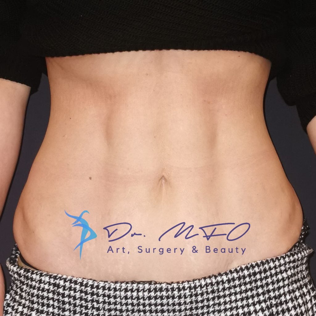 Venus Belly Tummy Tuck Abdominoplasty & 360 Lipo par le Dr MFO