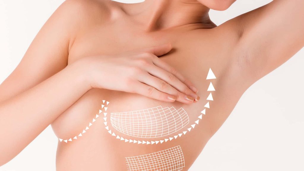 Breast Lift: How Is Mastopexy Done? 1