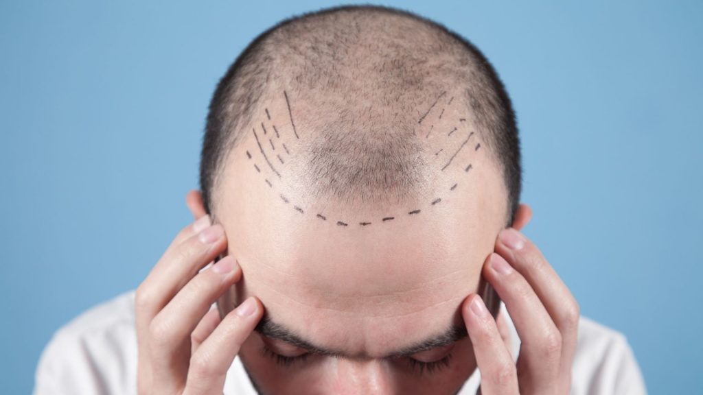 زراعة الشعر