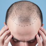 Trapianto di capelli