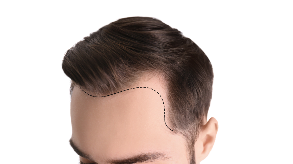 مركز زراعة الشعر