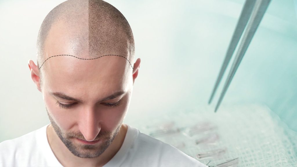 زراعة الشعر في تركيا