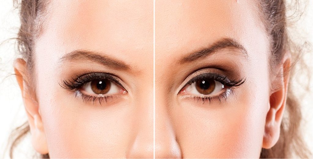 brow lift