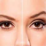 brow lift