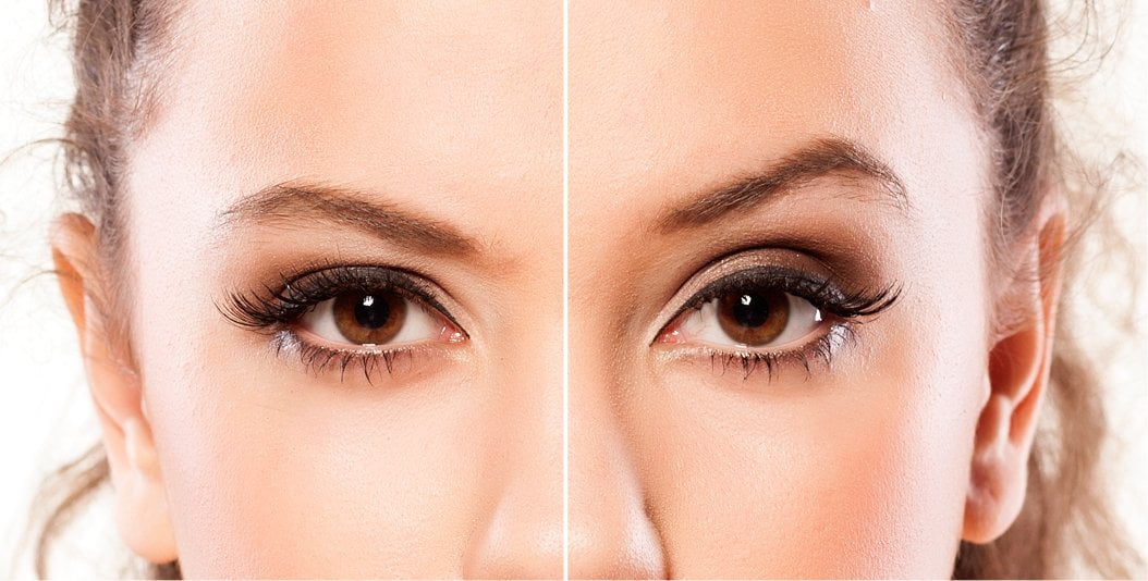 brow lift