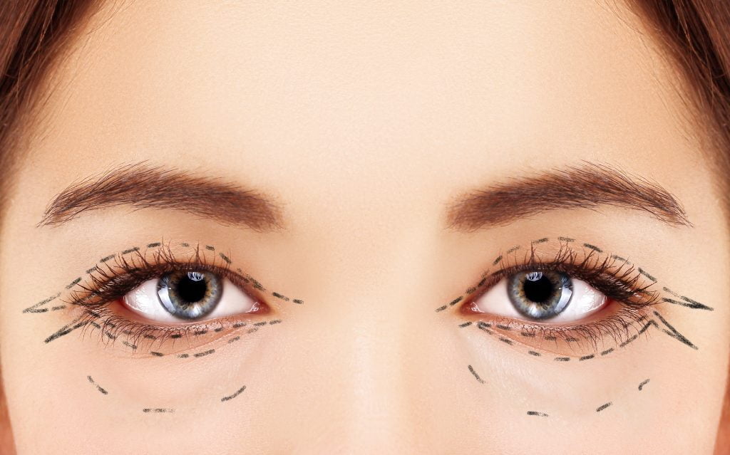 Lifting de ojos: obtenga una apariencia más brillante y juvenil en un solo procedimiento 2
