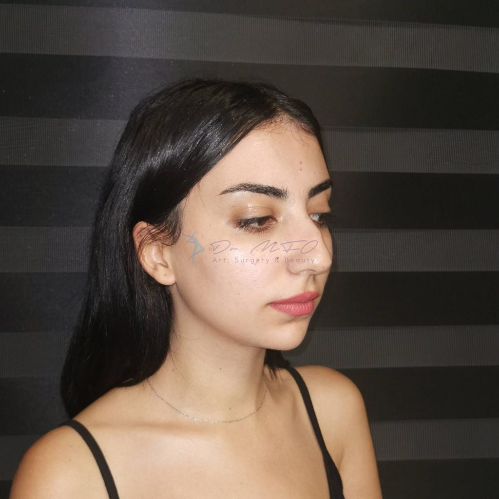 عملية تجميل الأنف