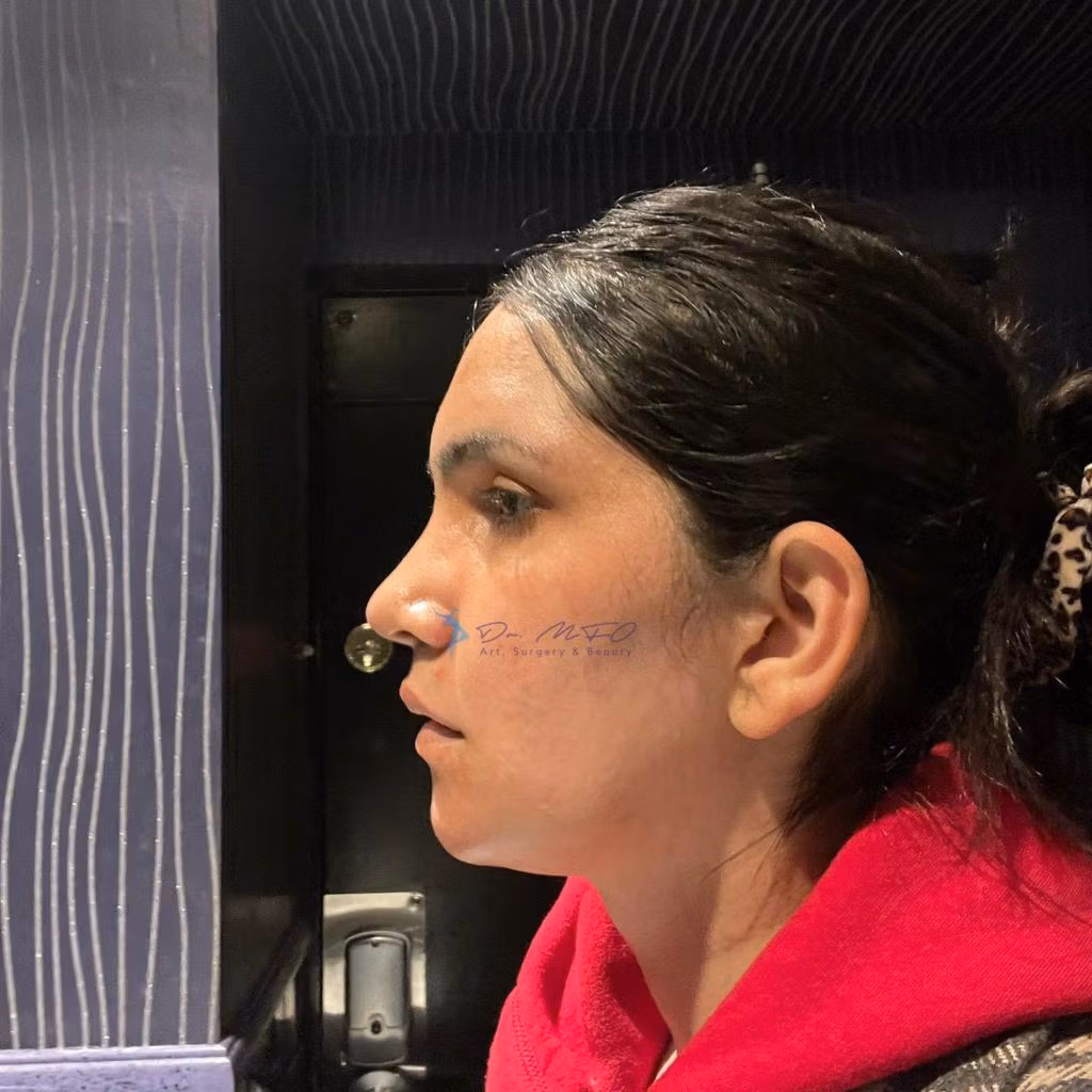 Facial Feminisation Surgery