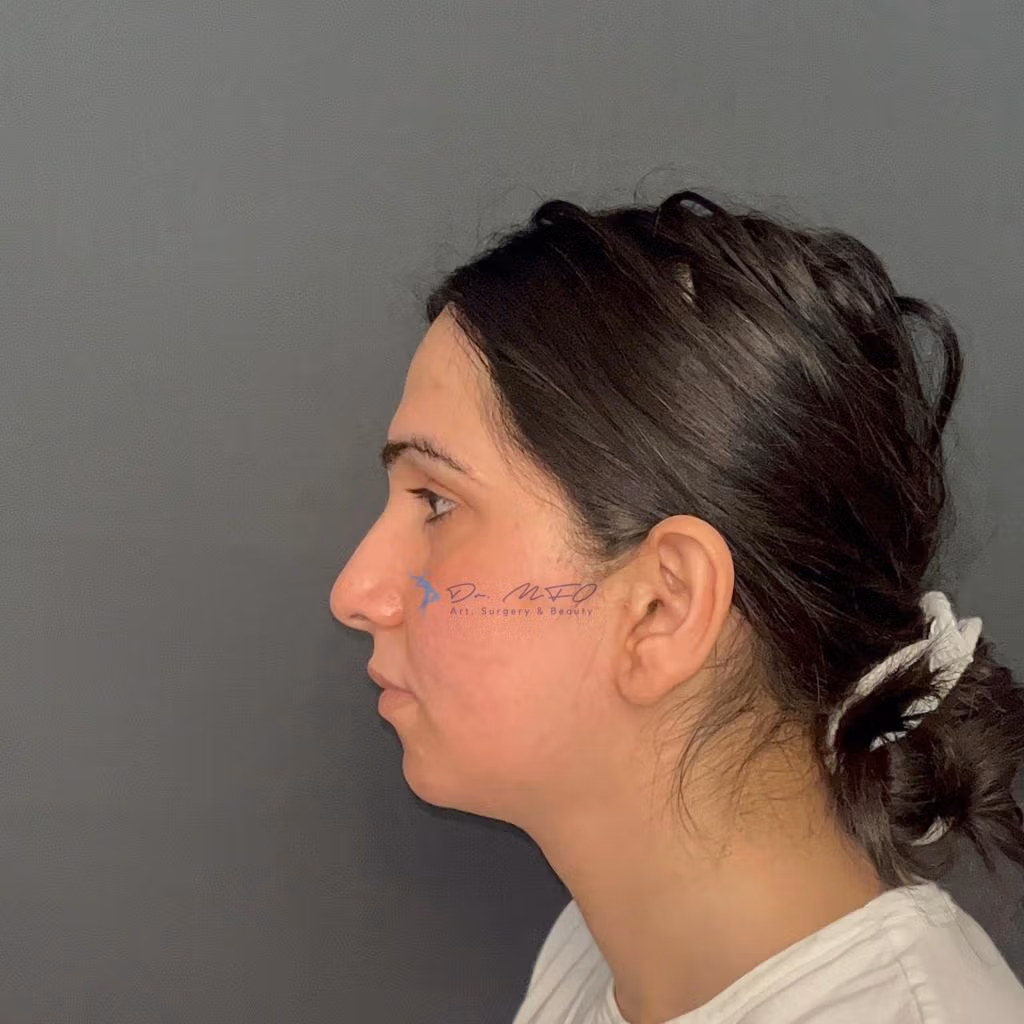 Facial Feminization Surgery