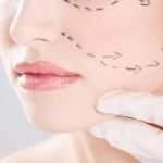 facelift surgery