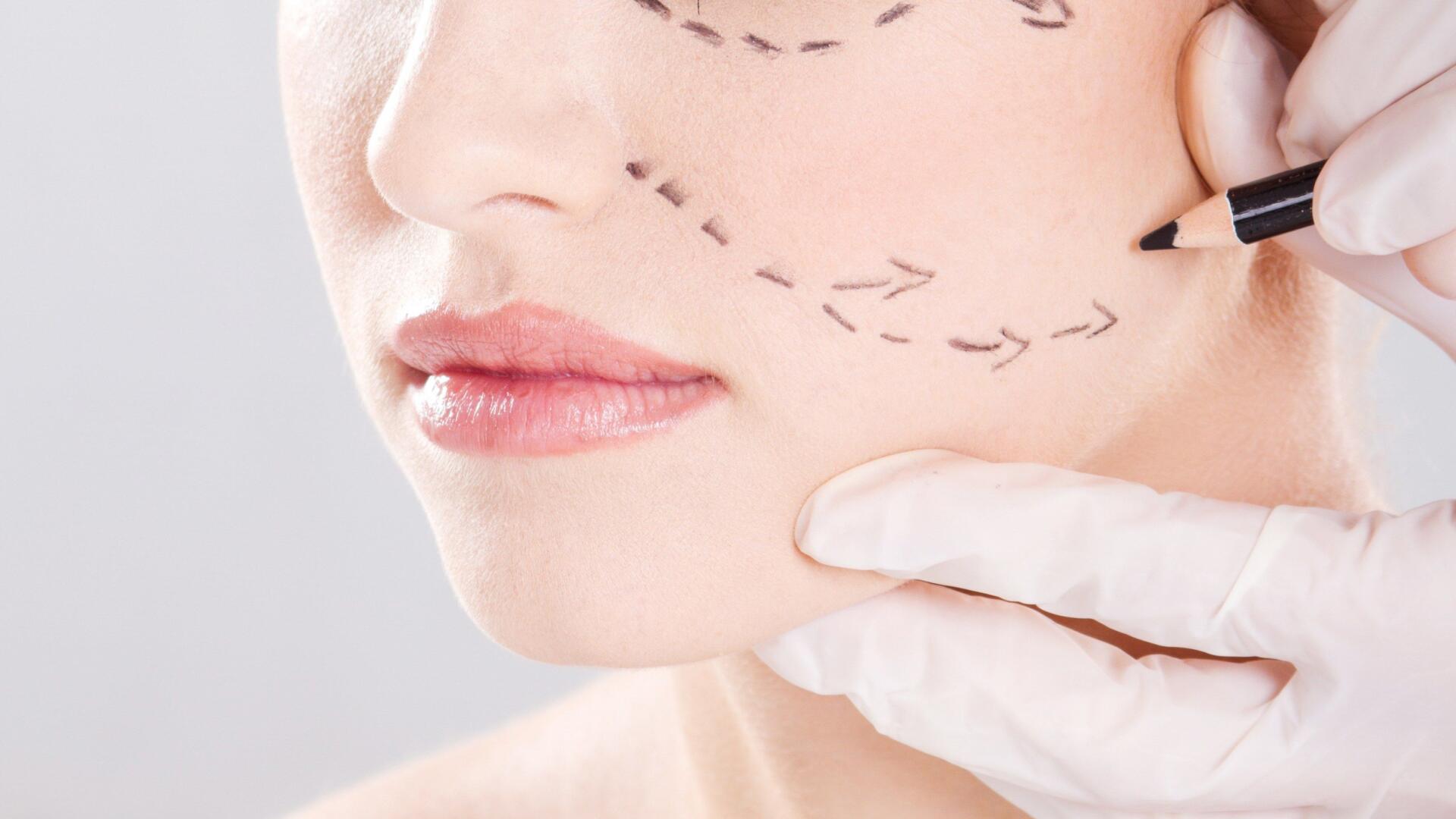 facelift surgery