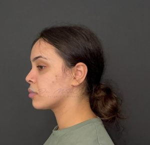 Comparaison avant-après des résultats d'une chirurgie de féminisation du visage. L'image met en évidence les modifications des traits du visage pour une apparence plus féminine.