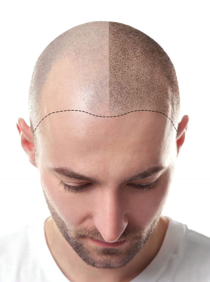 زراعة الشعر في تركيا