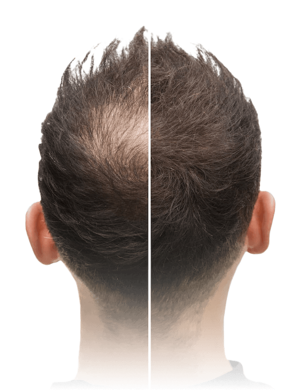 Haartransplantation in der Türkei