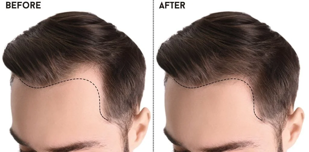 precio del trasplante de cabello en pavo