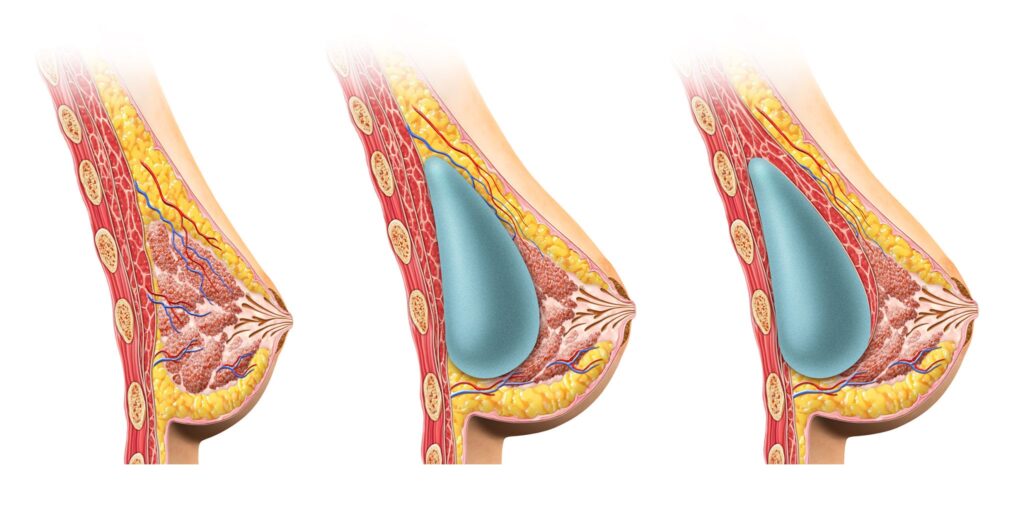 procedures of breast implants in turkey