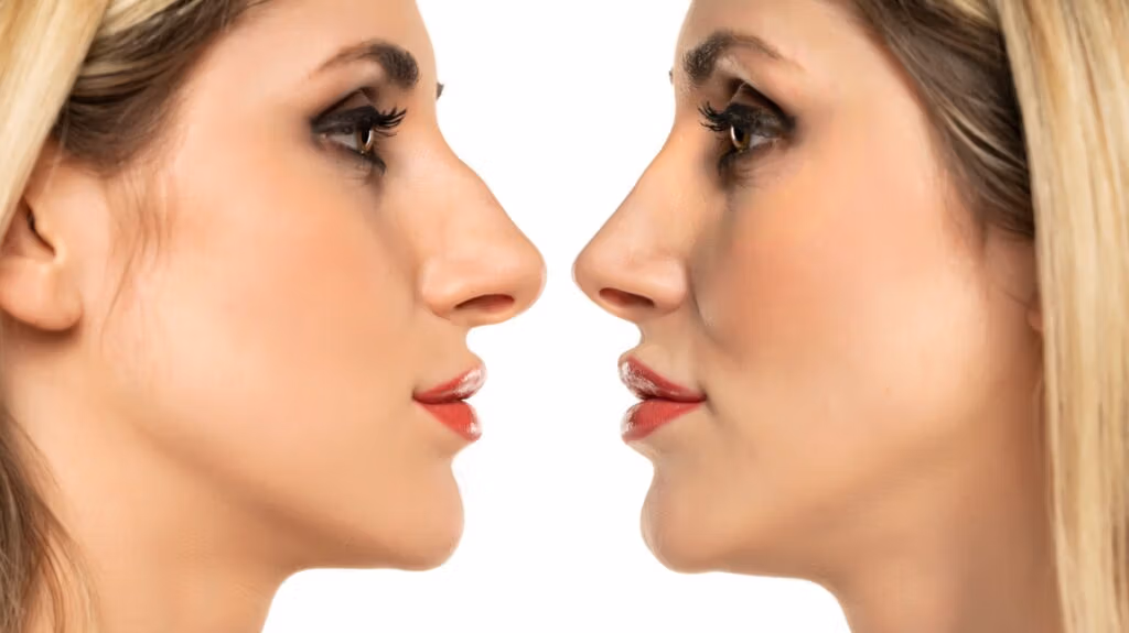 lip lift cost in Turkey