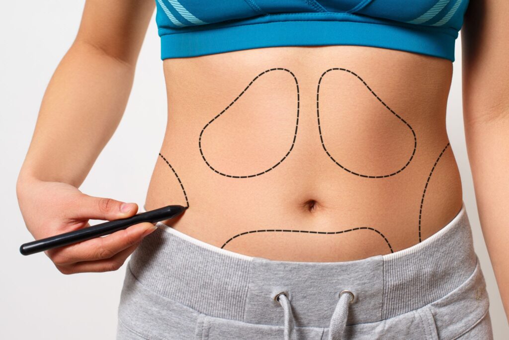 liposuction in antalya