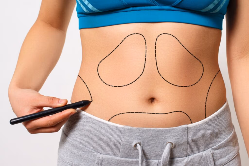 liposuction in antalya