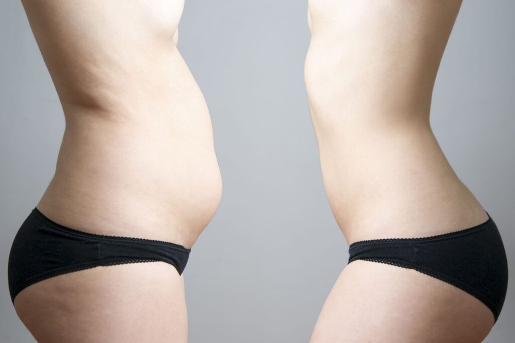 liposuction in antalya