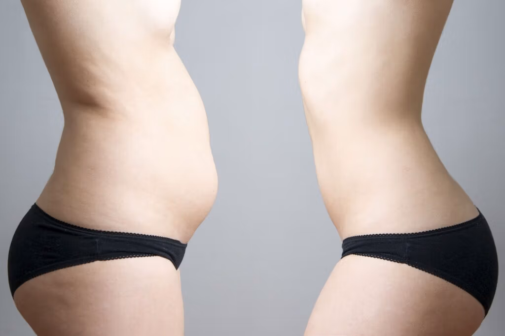 liposuction in antalya