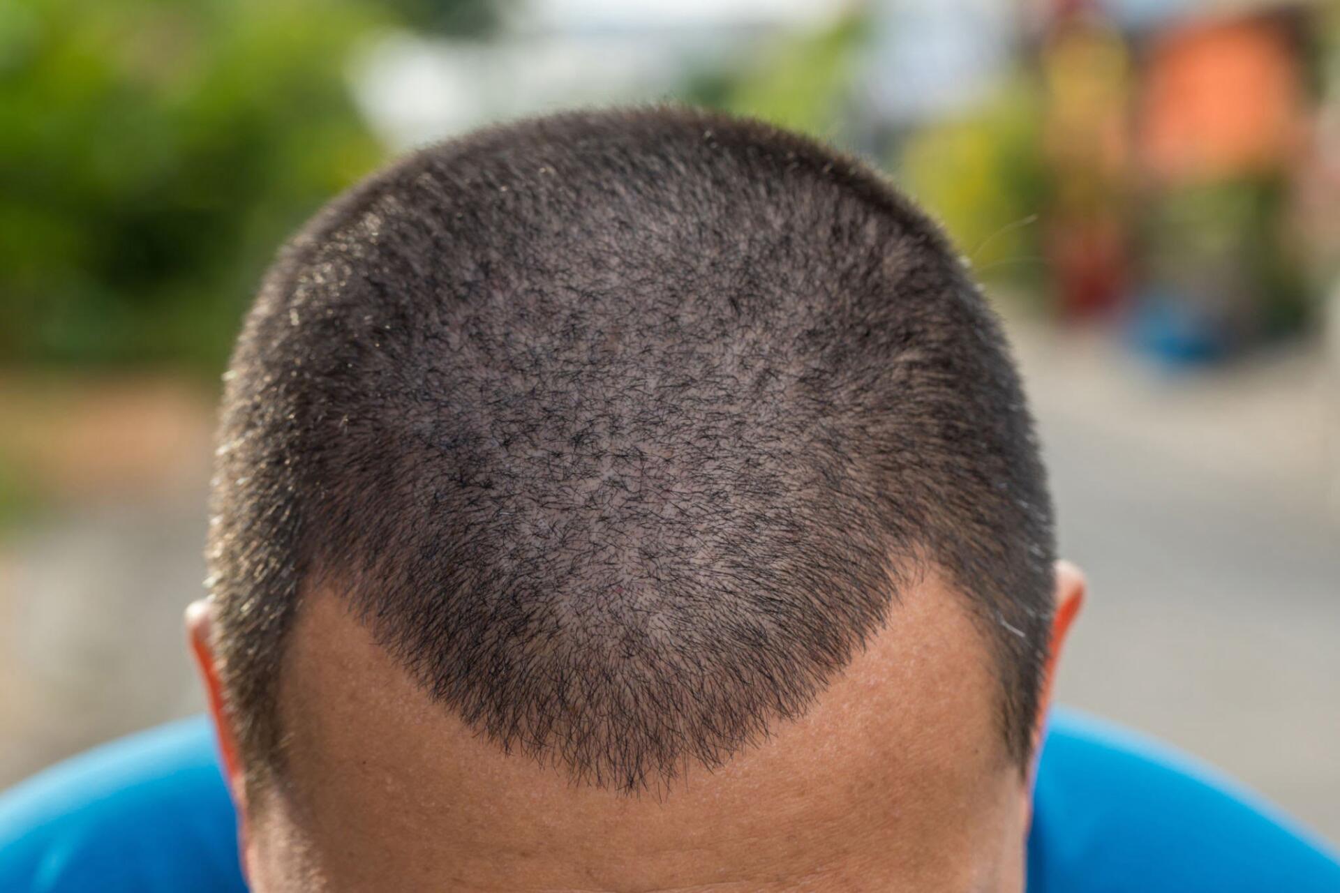 Man with short hair. Hair loss concept. Head of man.Hair Transplant in Turkey