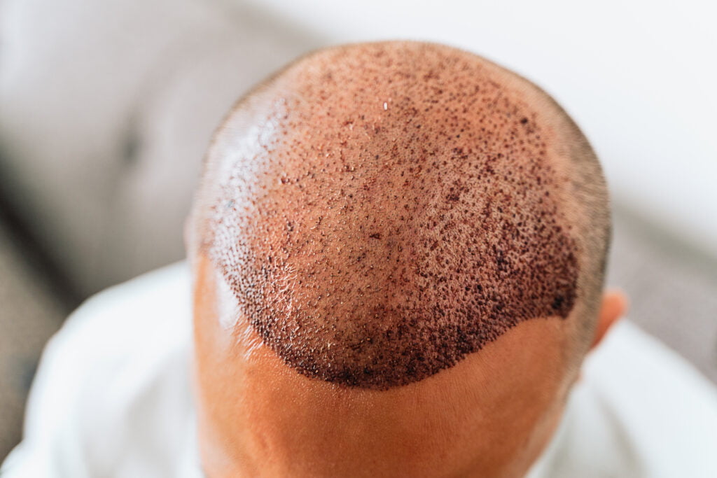 Après une greffe de cheveux, technique chirurgicale qui déplace les follicules pileux. Jeune homme chauve avec des problèmes de perte de cheveux.
