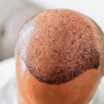 Tecnica chirurgica dopo il trapianto di capelli che sposta i follicoli piliferi. Giovane uomo calvo con problemi di caduta dei capelli.
