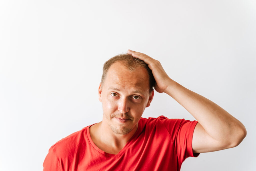 Avant la greffe de cheveux. Jeune homme chauve avec des problèmes de perte de cheveux tenant sa tête.