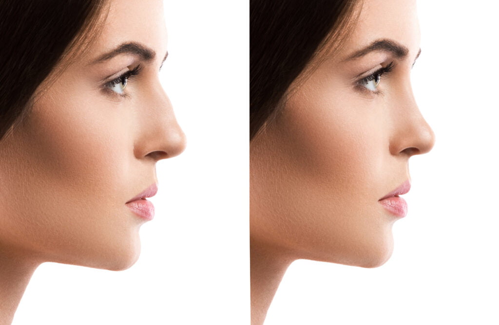 كيف يمكن لعملية تجميل الأنف أن تغير حياتك وكيفية اختيار أفضل جراح 2
