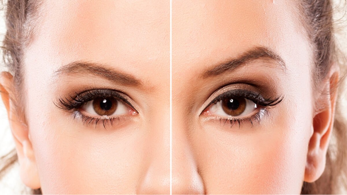 eyelid surgery in antalya