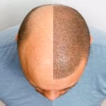 greffe de cheveux à Antalya