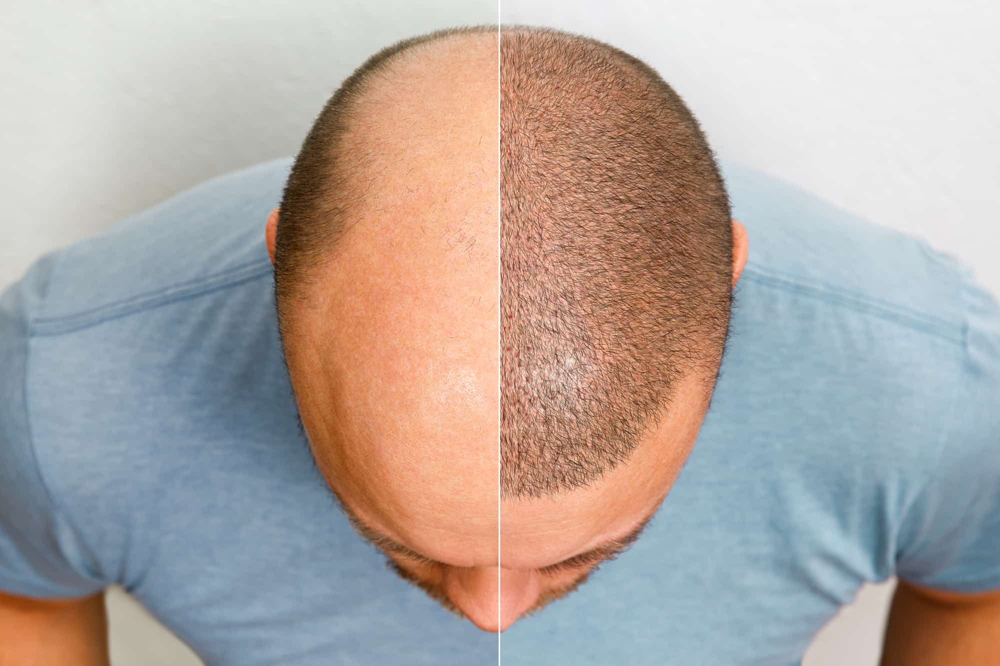 hair transplant in antalya