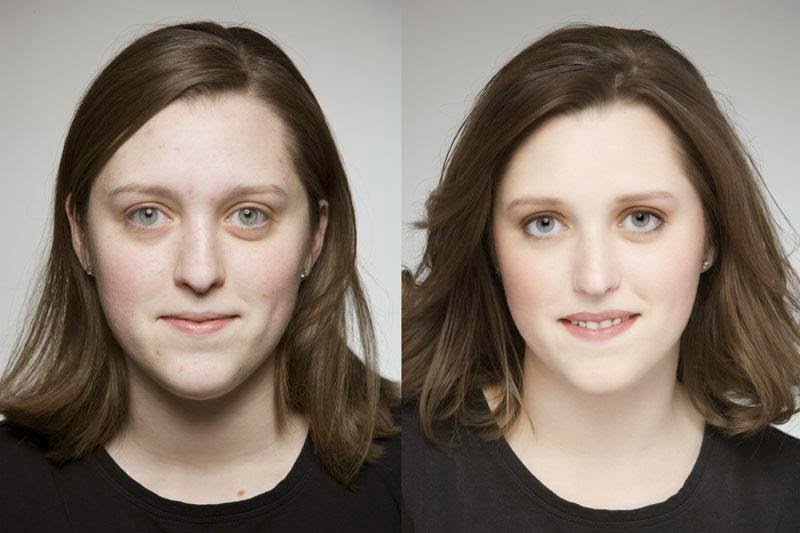 Qual è l'età minima per l'intervento di femminilizzazione del viso?