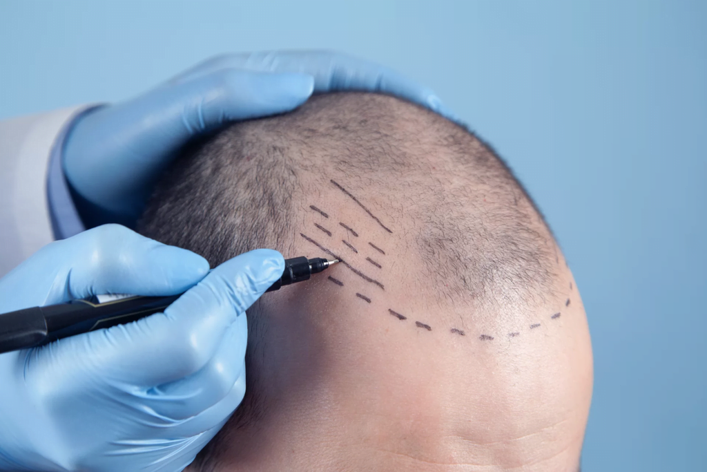 Quanto costa il trapianto di capelli da 5000 innesti nel Regno Unito? Perché dovresti scegliere Antalya per il trapianto di capelli?