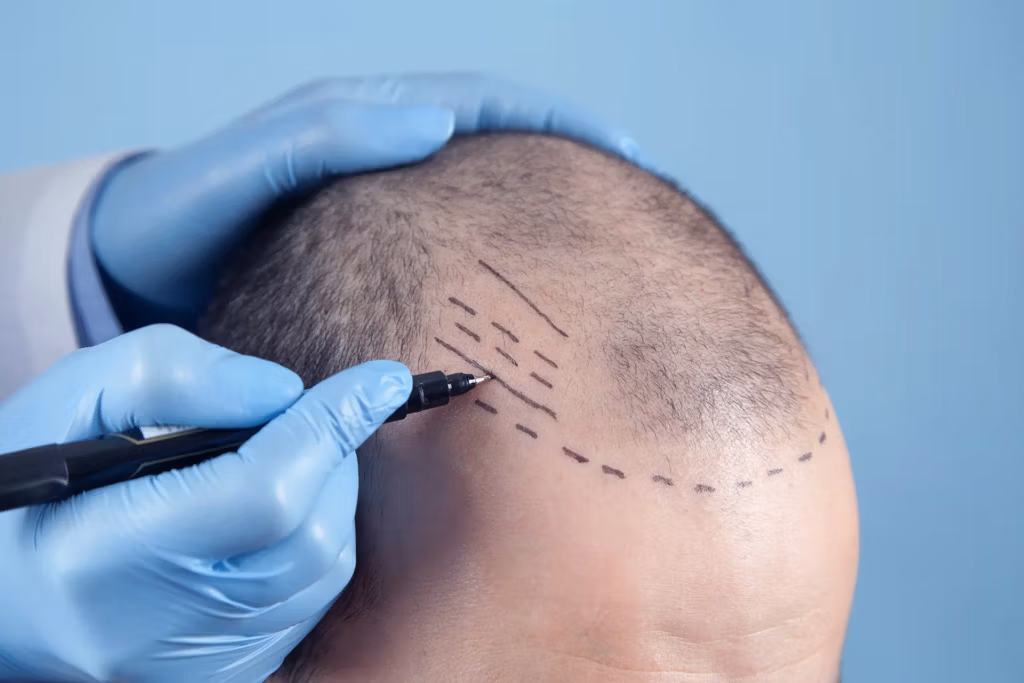Close-up of a person's scalp with surgical markings for hair transplant, with gloved hands holding a marker.