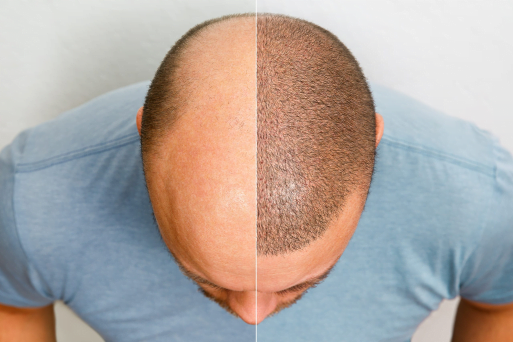 Quanto costa il trapianto di capelli da 5000 innesti nel Regno Unito? Perché dovresti scegliere Antalya per il trapianto di capelli?