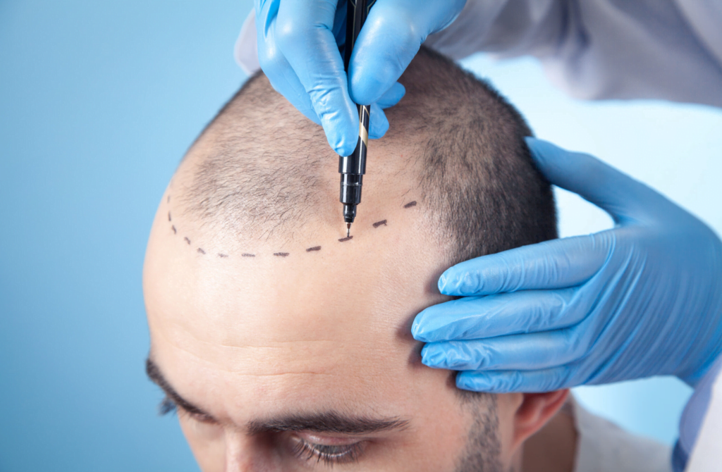 Ein Mediziner markiert während einer Haartransplantation die Kopfhaut eines Patienten mit einem Stift