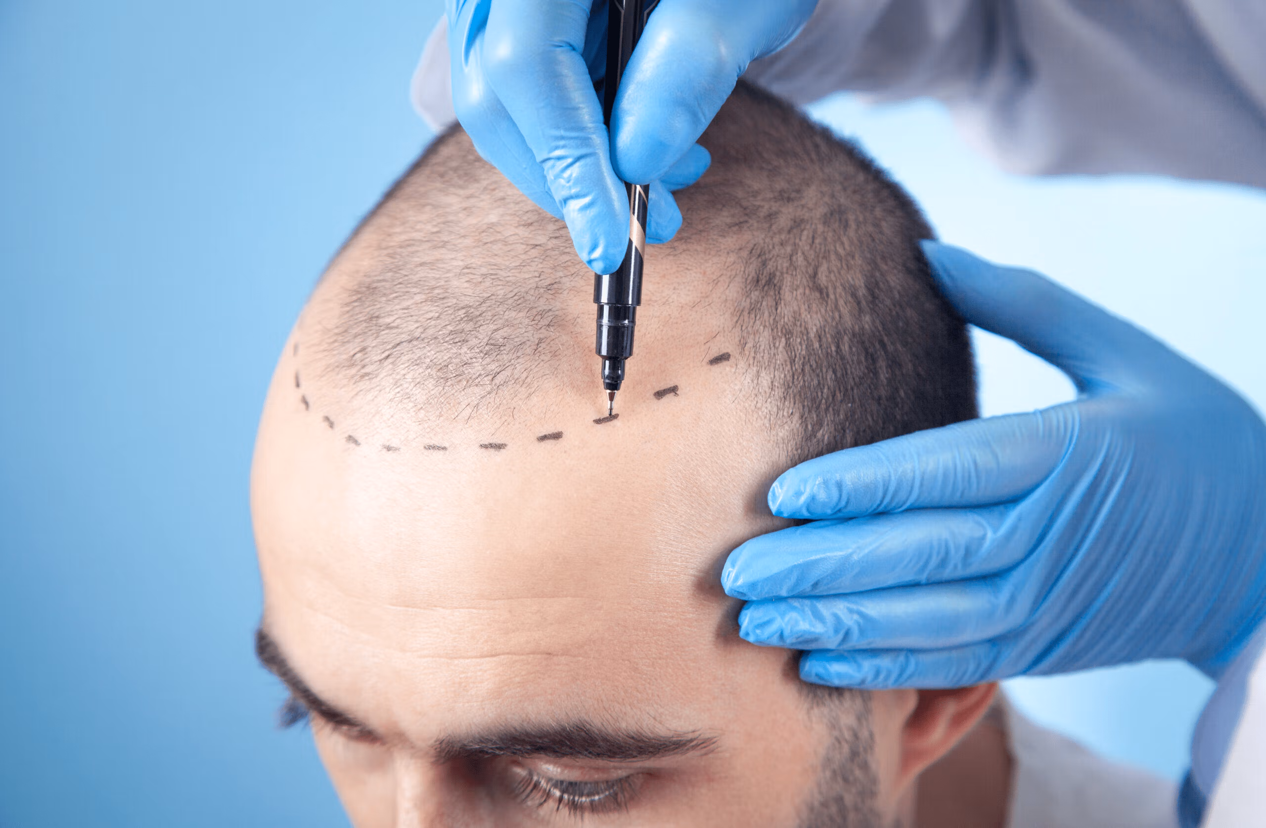 A medical professional marking a patient's scalp with a pen during a hair transplant procedure