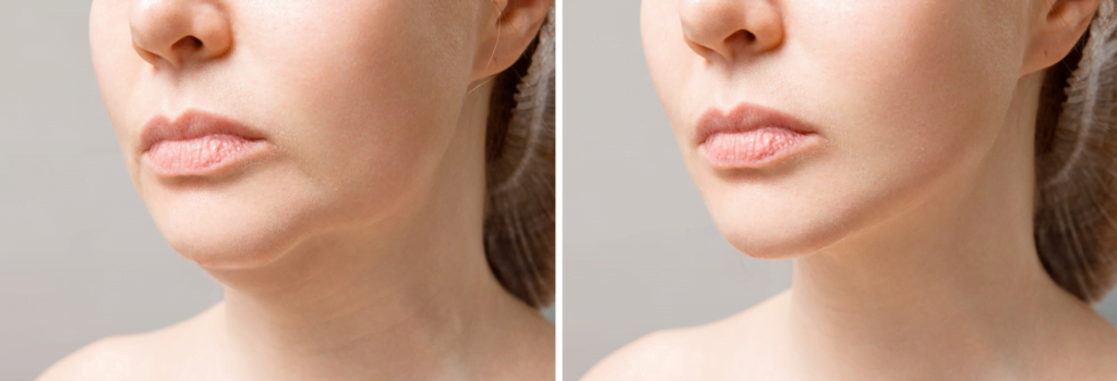 How much does chin feminization surgery cost?