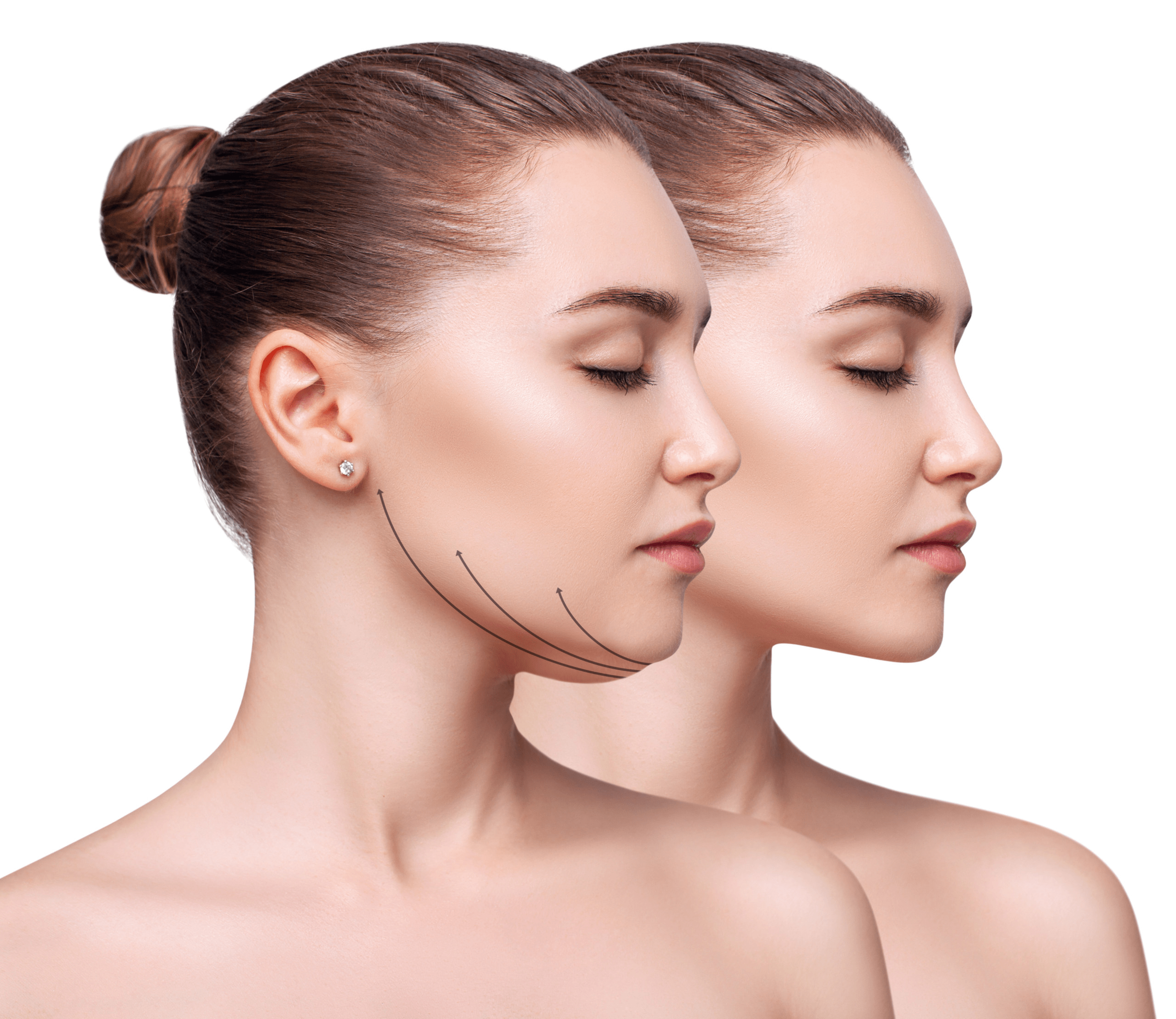 How much does chin feminization surgery cost?