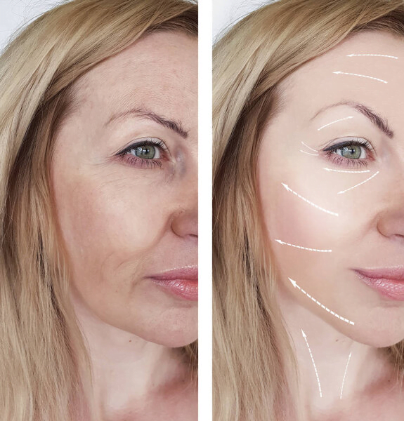 ¿Cuál es la edad mínima para la Cirugía de Feminización Facial?