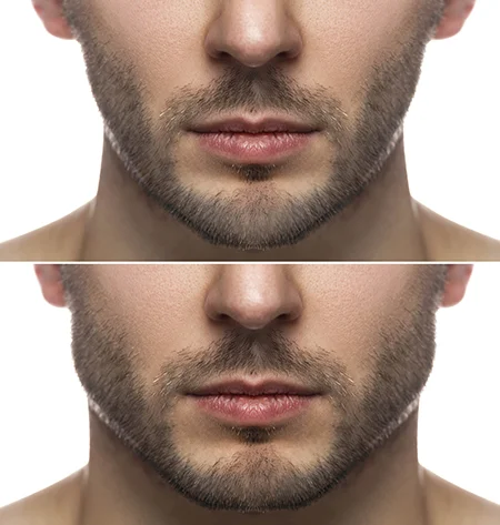 Is Wide Jaw Attractive? How Can You Look More Attractive With Jawline Surgery?
