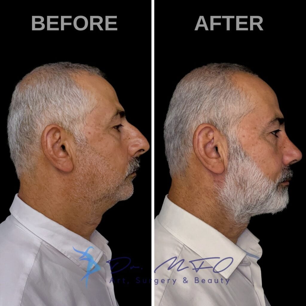Comparación del antes y el después de un hombre con vello facial, mostrando los resultados de un procedimiento cosmético. La imagen del antes muestra imperfecciones cutáneas notables y un perfil menos definido, mientras que la imagen del después revela una piel más suave, un perfil más definido y una estética facial general mejorada.