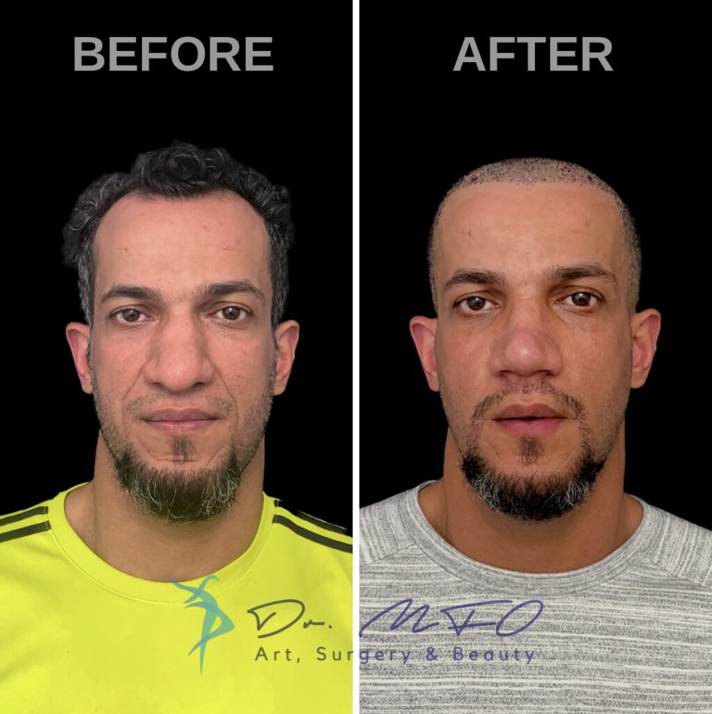 Comparación del antes y el después de un procedimiento de restauración capilar en un hombre. La imagen izquierda muestra al hombre con cabello ralo y entradas, vistiendo una camisa amarilla. La imagen derecha muestra al mismo hombre después del procedimiento, con cabello corto y abundante, uniformemente distribuido, vistiendo una camisa gris. Ambas imágenes tienen fondo negro y están etiquetadas como "ANTES" y "DESPUÉS", respectivamente.