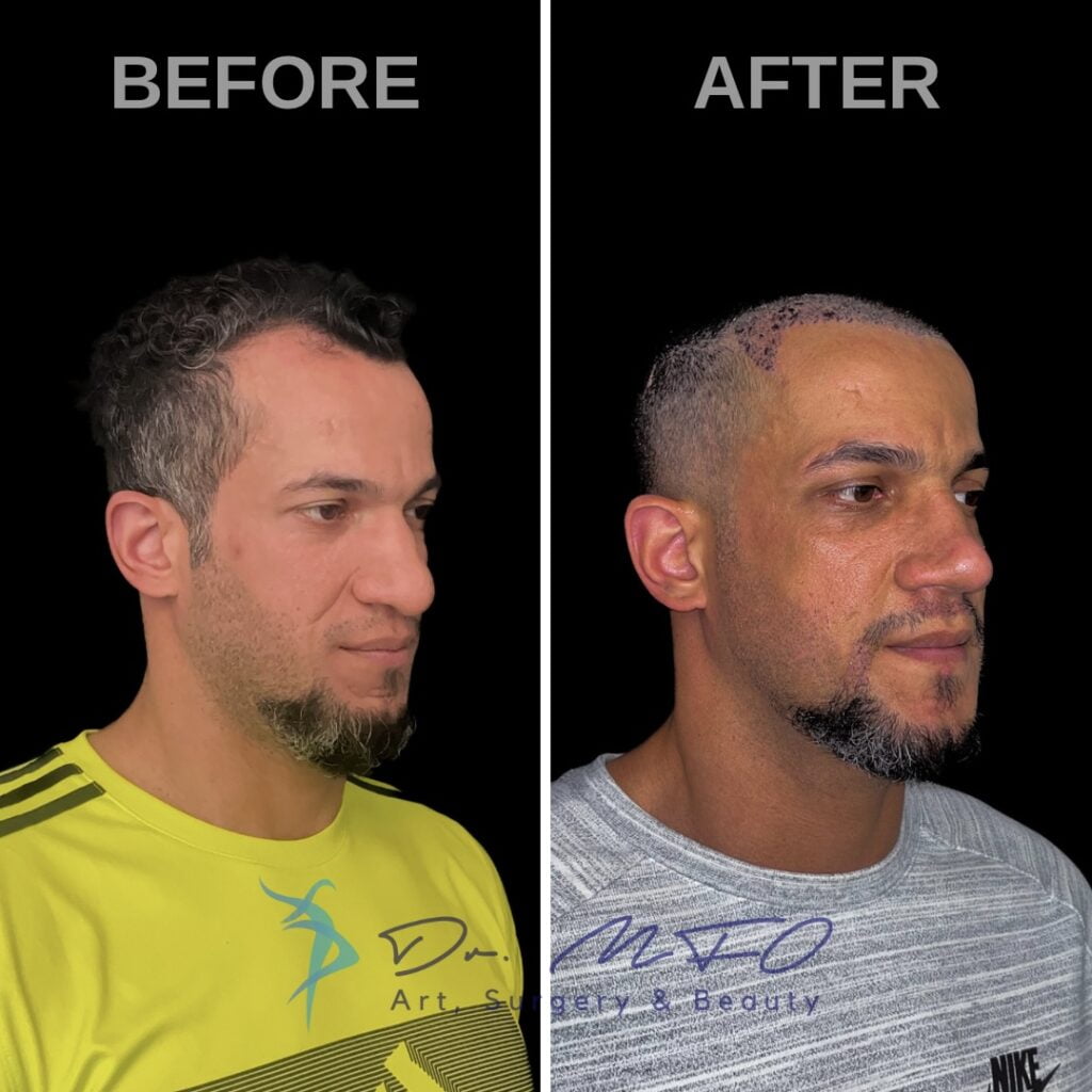 Comparación antes y después de un hombre que se sometió a un procedimiento de trasplante de cabello, que muestra una mejora significativa en la densidad y cobertura del cabello.